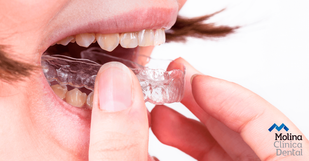 Cómo limpiar y mantener en buen estado las férulas dentales